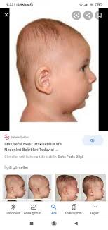 Yeni dogan bebekteki sekil bozukluklari normal mi saglik haberleri. Rampa Yapmis Kafasi O Ne Demekse 3 6 Ay Arasi Bebekler