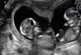 Finden sie schnell einen spezialisten für ultraschall / sonografie in wesseling oder einen behandler und vereinbaren sie ihren termin mit wenigen klicks kostenlos online. Eineiige Oder Zweieiige Zwillinge Seite 2 Babywelten Ch