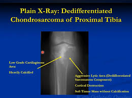 Image result for Chondrosarcoma