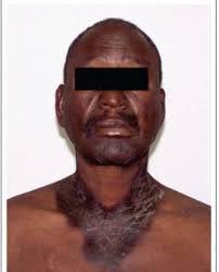 Can a tuberculosis patient have intercourse with their partner?