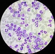 Leucemia mieloide cronica negli stati uniti alcuni anni fa negli stati uniti, per esempio. Leucemia Mieloide Cronica Wikiwand