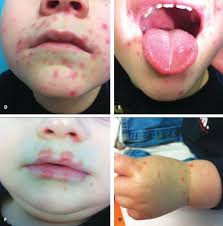 Hand Foot And Mouth Disease Consultant For Pediatricians Hand Foot And Mouth Disease Mouth