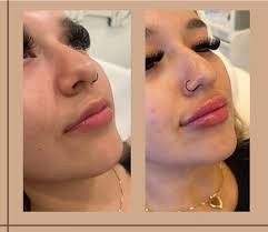 💋💋💋💋💋💋💋💋💋 💉Product: Juvederm Ultra XC 💰Price: $750+ 🗓️Duration:  1 year 📍74320 Highway 111 Palm Desert CA 📞 Call to schedule: (760)  423-5610 🧑🏻‍⚕️Injector: PA Logan 🩺medical director/ Owner : Dr. Taheri