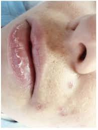 Accutane is safer than blogwriters and media would have you beleive. Challenges And Solutions In Oral Isotretinoin In Acne Reflections On Ccid