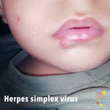 Gingivostomatitis is a condition that may arise in toddlers or young children. Herpes Simplex Virus Skin Deep