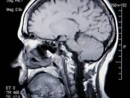 We did not find results for: Migraines Can Alter Brain Structure Permanently