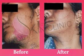 Indeed, buying packages for each area individually is. Laser Hair Removal In Jalandhar Affordable Treatment In Punjab