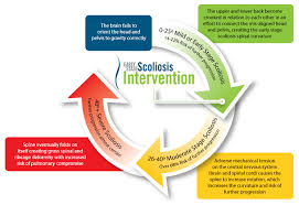 Get More Information On The Scoliosis Progression Cycle Scoliosis Scoliosis Surgery Surgery