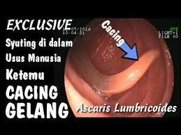Dapatkah saya membasmi cacingan sendiri secara. Penampakan Cacing Di Dalam Tubuh Manusia Cara Rekam Saluran Cerna Ada Link Di Deskripsi Youtube