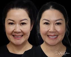 A perfecting touch for a beautiful, confident smile