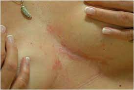 Intertrigo is an inflammatory skin condition that can be caused and worsened by many factors. Intertrigo Springerlink