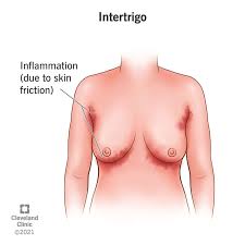 Image result for heat rash under breasts