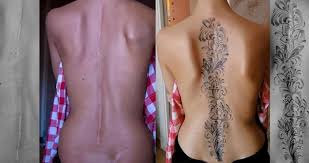 How do you care and therapy is useful against keloids? The Unique Scar Bearer Painfulpleasures Inc