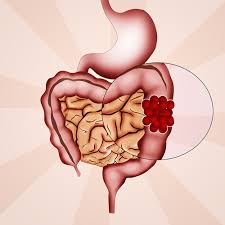 Sengupta mentioned, it typically takes years, barring lynch. Oral Bacterium May Help Colorectal Cancer Spread