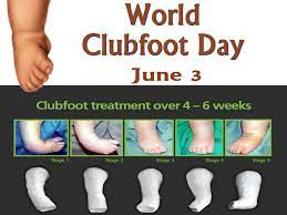 World Clubfoot Day Holidays That Might Get Overlooked Facebook