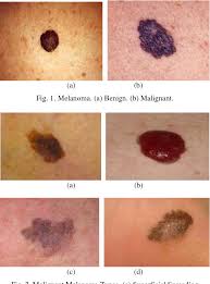 Recognize the characteristics of melanoma. Figure 1 From Early Detection And Classification Of Melanoma Skin Cancer Semantic Scholar