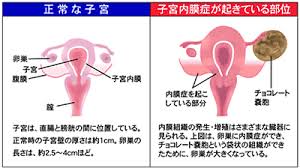 「卵巣がん 原因」の画像検索結果