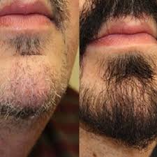 ‫کاشت ریش و سبیل | روش ها، مراحل و هزینه کاشت ریش صورت‬‎