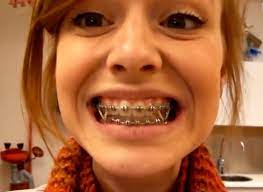 Braces Braces Girls Braces Cute Braces