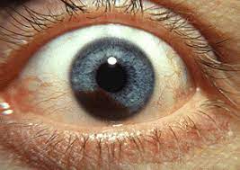 The iris (the colored part of the eye); Uveal Melanoma Wikipedia