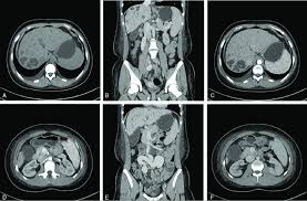 What is the difference between ct scan vs mri scan. Pictures Of Ct Scans Of The Patient A And B Non Enhanced Ct Images Download Scientific Diagram