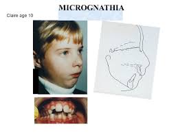 Image result for Micrognathia