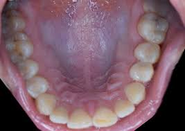 Image result for Physical injury red spots roof of mouth