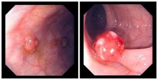 Avoid using a colon before a list if it directly follows a verb or preposition that would ordinarily need no punctuation in that sentence. Polyps Of The Colon And Rectum Digestive Disorders Msd Manual Consumer Version