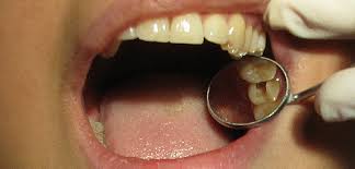 A root canal, or more accurately a root canal treatment, is performed when the dental pulp of a tooth dies or you have an infection in or under the tooth. Tooth Restoration After A Root Canal Inner Banks Dental