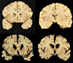 Cnn chief medical correspondent dr. Many Football Players Have Mild Severe Chronic Traumatic Encephalopathy Neurology Advisor