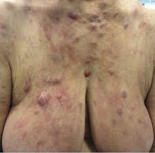 These symptoms are the result of an immune reaction to anomalous proteins being produced by the cancer cells. 10 Other Cutaneous Nk T Cell Lymphomas Plastic Surgery Key