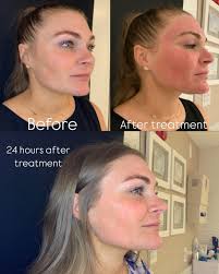 Microneedling + Exosomes = Rapid Glow-Up ✨ Swipe to see the transformation!  Our client paired microneedling with exosome therapy, and just 24 hours  later, their skin is already healing beautifully. Exosomes work