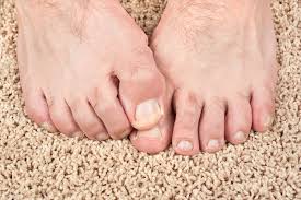 Yellow teeth causes when you smoke to much and the top of your tongue turn black and looks like you have hair on it. Dr Graham Answers The Question How To Get Rid Of Yellow Toenails Hyprocure The Proven Solution To Misaligned Feet
