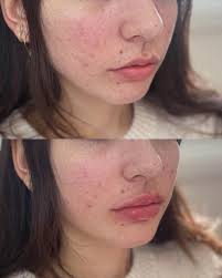 Profile for Nurse Injector Lisa