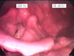 Image result for Acute Laryngitis