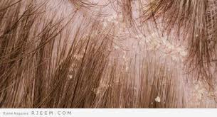 التخلص من فطريات الشعر علاج مشكلة فطريات الشعر مجلة رجيم