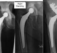 Is cemented metal-polyethylene 22.2 mm hip arthroplasty a ...