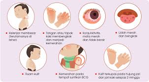 Apabila bayi demam panas, ibu adalah insan yang akan risau melihat keadaan anak kecil yang tak sihat. Mengenali Penyakit Kawasaki Positive Parenting