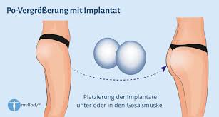 A) can a buttock lift be combined with other procedures? Po Vergrosserung Mit Silikonimplantat Po Implantate
