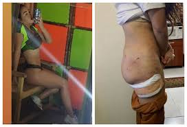 Yina mostró un impactante antes y después de su última operación. Yina Calderon Se Quito Biopolimeros De La Cola Por Afectaciones De Salud Alerta Bogota