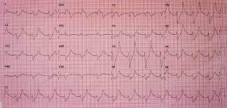 Image result for Hyperkalemia