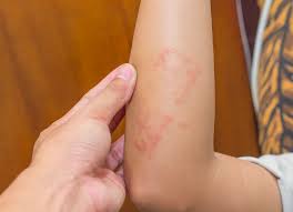 Maybe you would like to learn more about one of these? Jenis Jenis Infeksi Jamur Kulit Ringworm