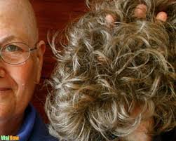 Stop And Reverse Pcos Hair Loss Visihow