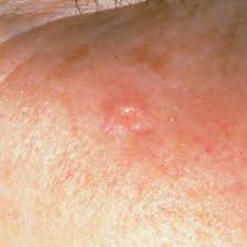 Image result for Sebaceous Hyperplasia
