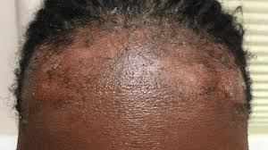 Image result for sores on the head in children