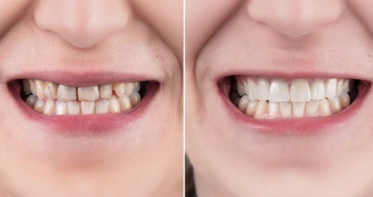 Comparatif clinique montrant la correction des teintes et des alignements par facettes, AI generated