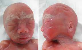 528 likes · 1 talking about this · 99 were here. Fetoplacental Cytogenetic Discrepancy In A Pregnancy With Fetal Mosaic Tetrasomy 12p And Pallister Killian Syndrome Detected By Amniocentesis Sciencedirect