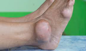 Gout in Ankle