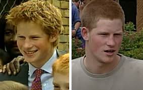 Prince Harry's Hair Transplant