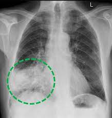 Lungendiagnostik Radiologie Darmstadt